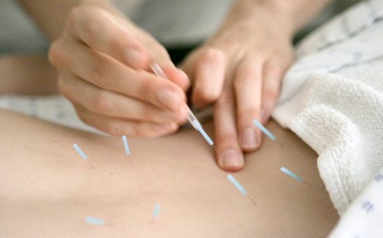 Back Pain Acupuncture 