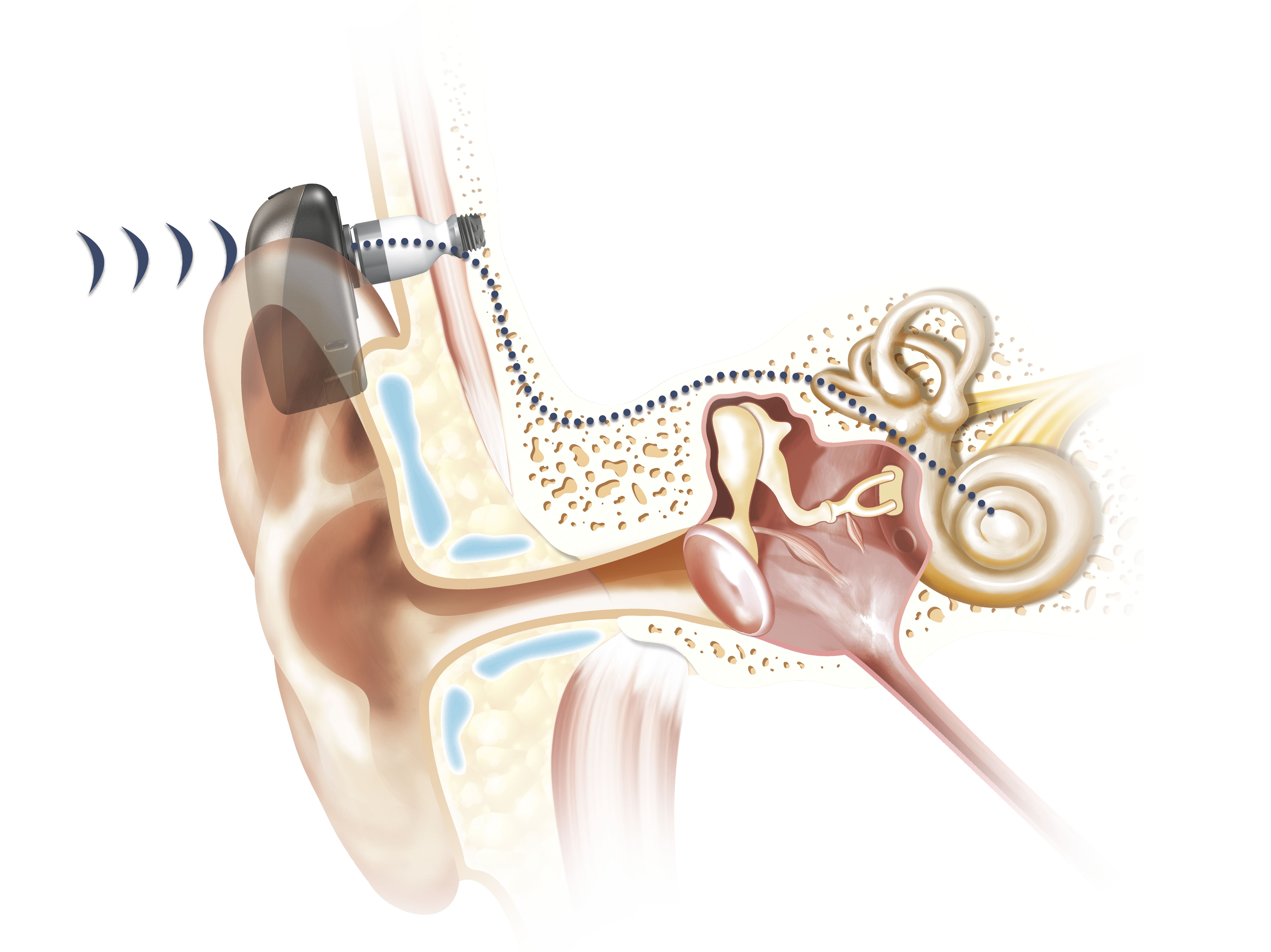 Tegningen viser viser hvordan et benforankret høreapparat overfører lyd. Illustrasjon fra Cochlear